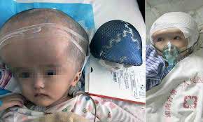 اولین کودک دنیا با جمجمه تیتانیومی