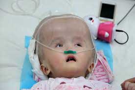 اولین کودک دنیا با جمجمه تیتانیومی