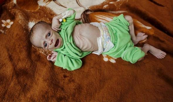تصاویر : قحطی در یمن