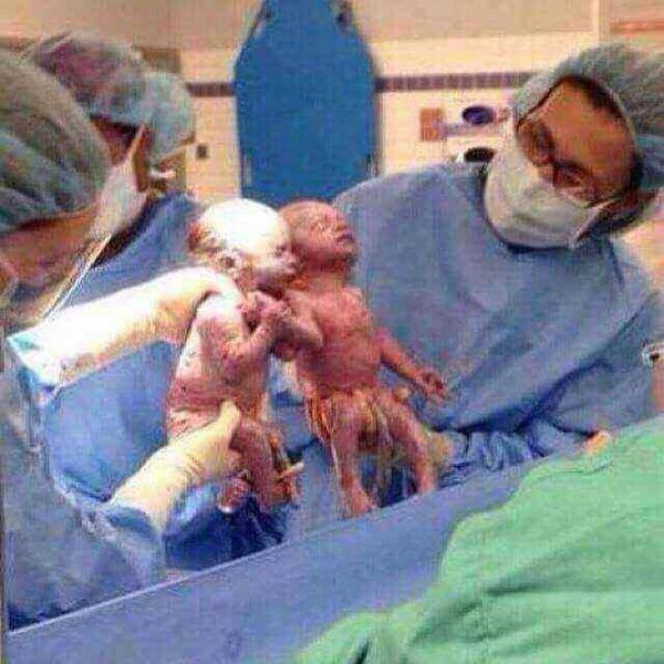 عکس:دوقلوهایی که تا لحظه به دنیا آمدن، دستان یکدیگر را رهانکردند