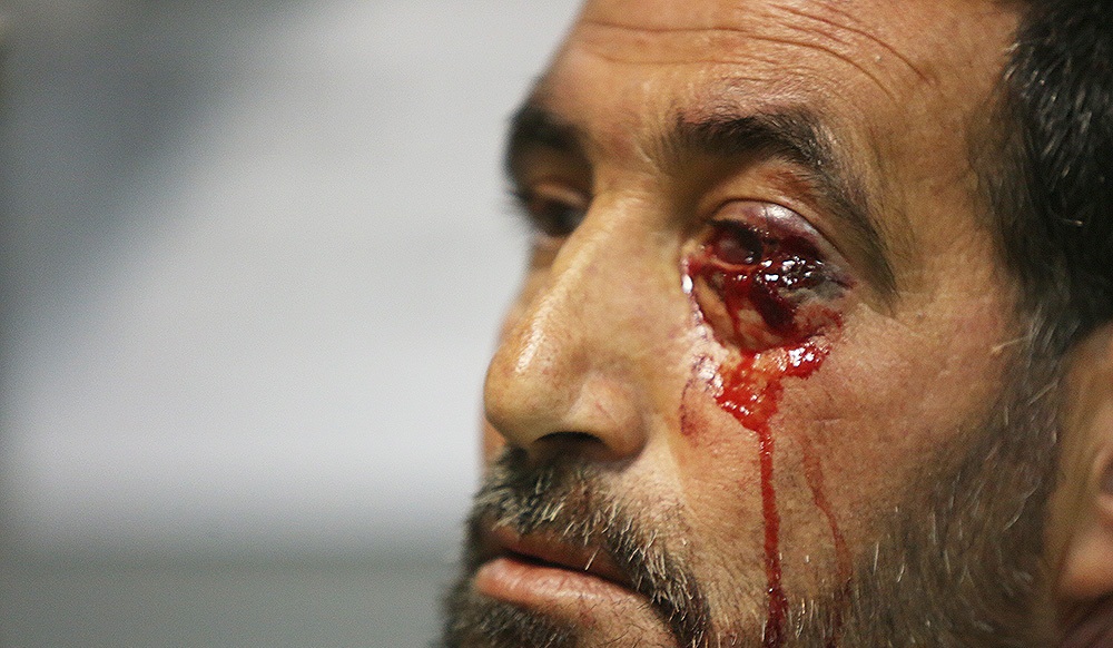 تصاویر : آسیب دیدگان حوادث چهارشنبه سوری