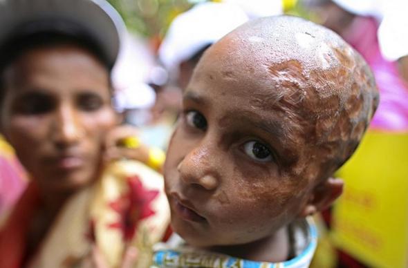 تصاویر : قربانیان اسیدپاشی