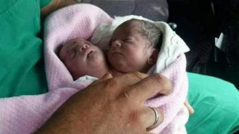 عکس/نوزادی که با ۲ سر به دنیا آمد