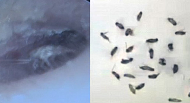 خارج کردن ۲۶ سوسک از گوش مرد چینی خارج کردن ۲۶ سوسک از گوش مرد چینی