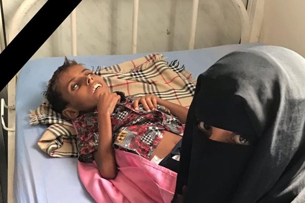 کودک 10 ساله؛ اولین قربانی قحطی بر اثر محاصره الحدیده یمن + عکس