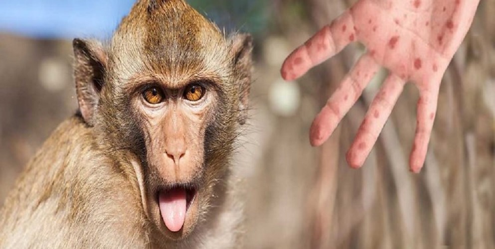 ردپای آبله میمونی در 105 کشور دنیا