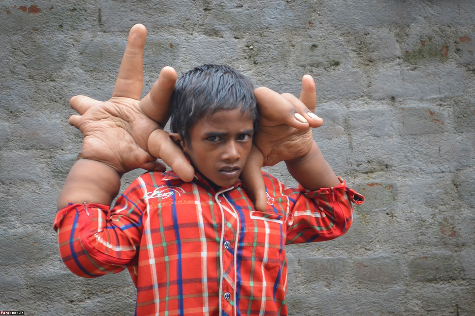 بیماری عجیب پسربچه هندی/ عکس