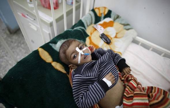 تصاویر : قحطی در یمن