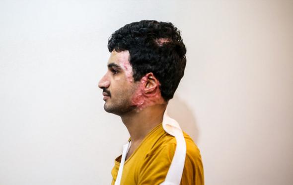 تصاویر : مجروحان جنگ یمن در تهران