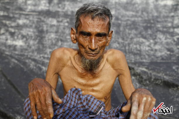 تصاویر : سوءتغذیه شدید آوارگان روهینگیا
