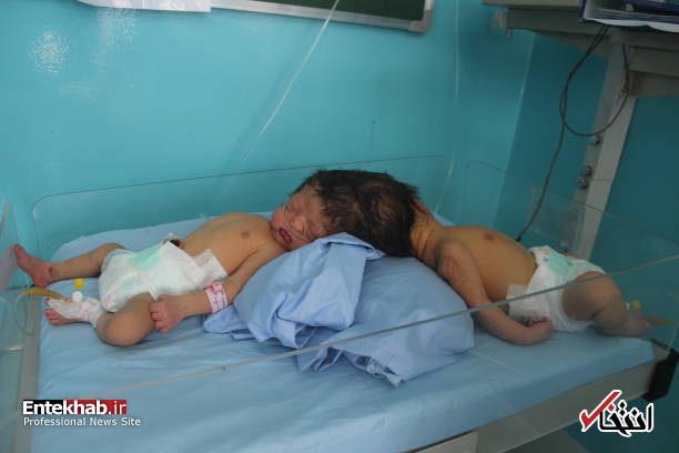 عکس/ تولد دوقلوهای بههم چسبیده در بدخشان افغانستان