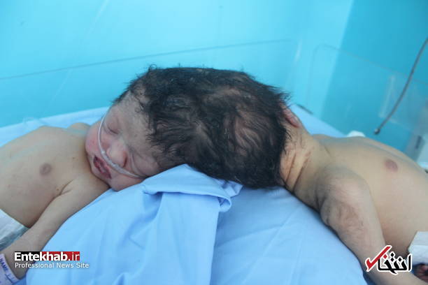 عکس/ تولد دوقلوهای بههم چسبیده در بدخشان افغانستان