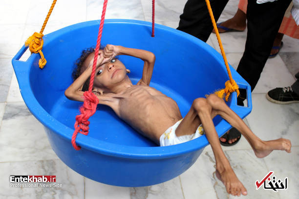 عکس/ سوءتغذیه شدید کودک یمنی