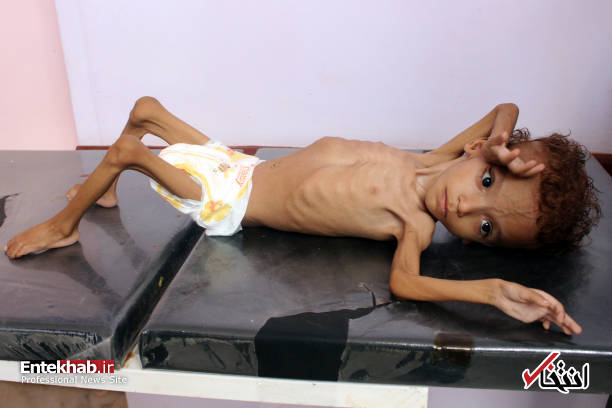 عکس/ سوءتغذیه شدید کودک یمنی