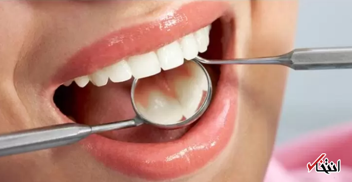 چرا دندانهای من مرتب دچار پوسیدگی می شوند؟