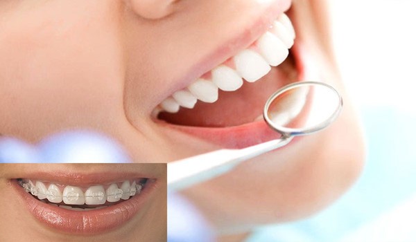 برای منظم شدن دندان ها لمینت بهتر است یا ارتودنسی نامرئی؟
