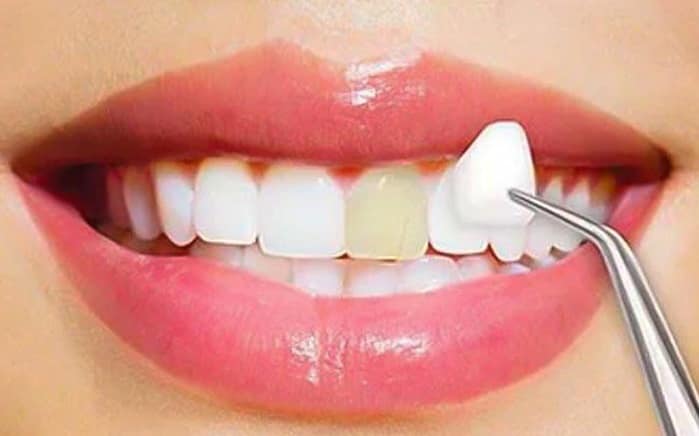 برای منظم شدن دندان ها لمینت بهتر است یا ارتودنسی نامرئی؟ برای منظم شدن دندان ها لمینت بهتر است یا ارتودنسی نامرئی؟