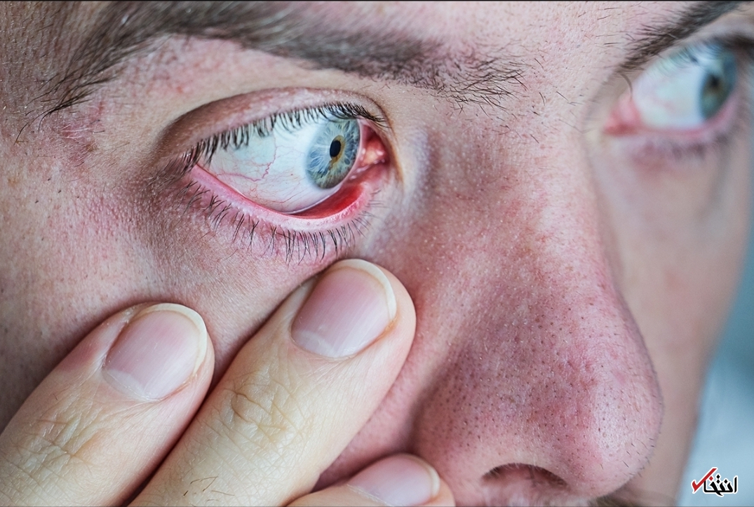 خطر «سندرم خشکی چشم» برای کاربران تلفن همراه