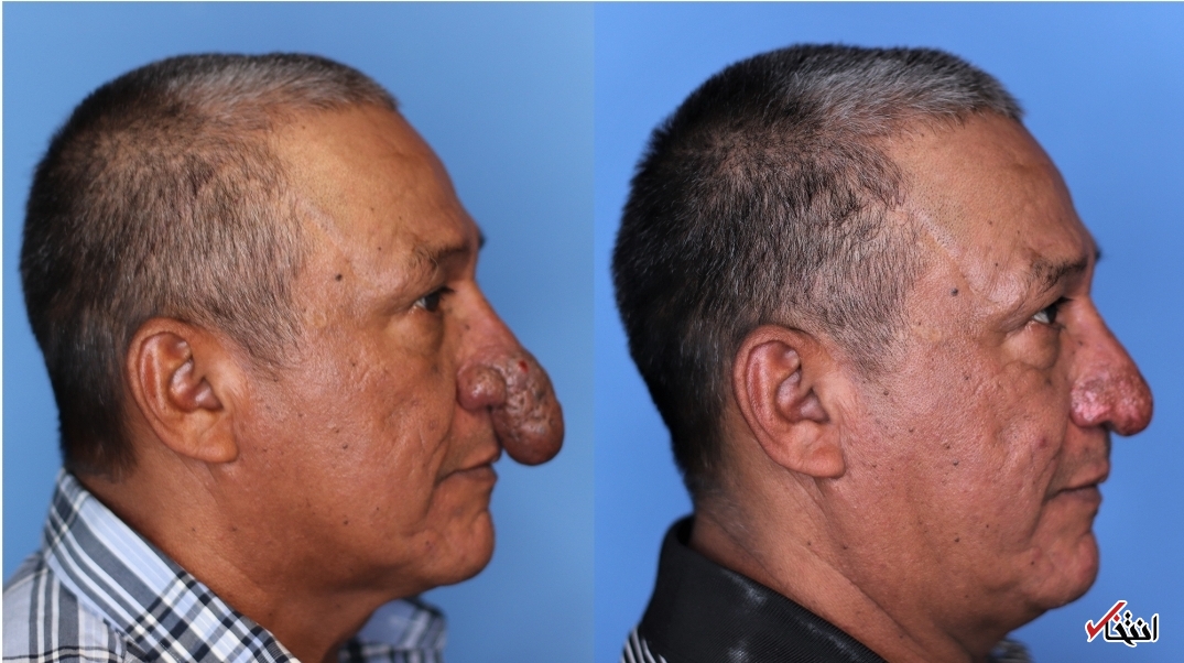 جراحی خیره کننده بینی یک مرد ۵۷ ساله+تصاویر