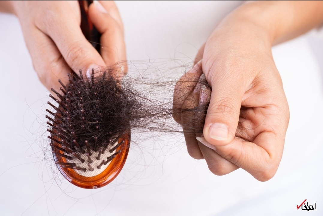 کابوسی به نام ریزش مو/از علل تا راهکار‌های درمان