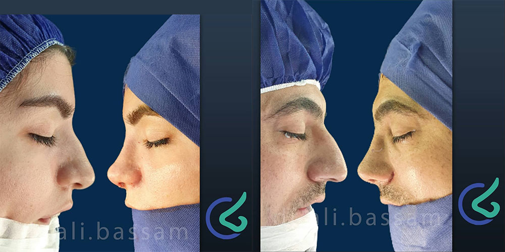 جراحی بینی بدون تامپون امکان پذیر است؟ جراحی بینی بدون تامپون امکان پذیر است؟