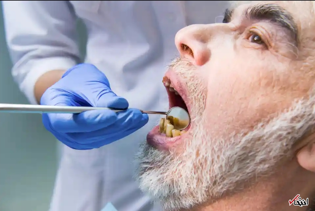 افزایش خطر ابتلا به کرونا با ضعف بهداشت دهان و دندان