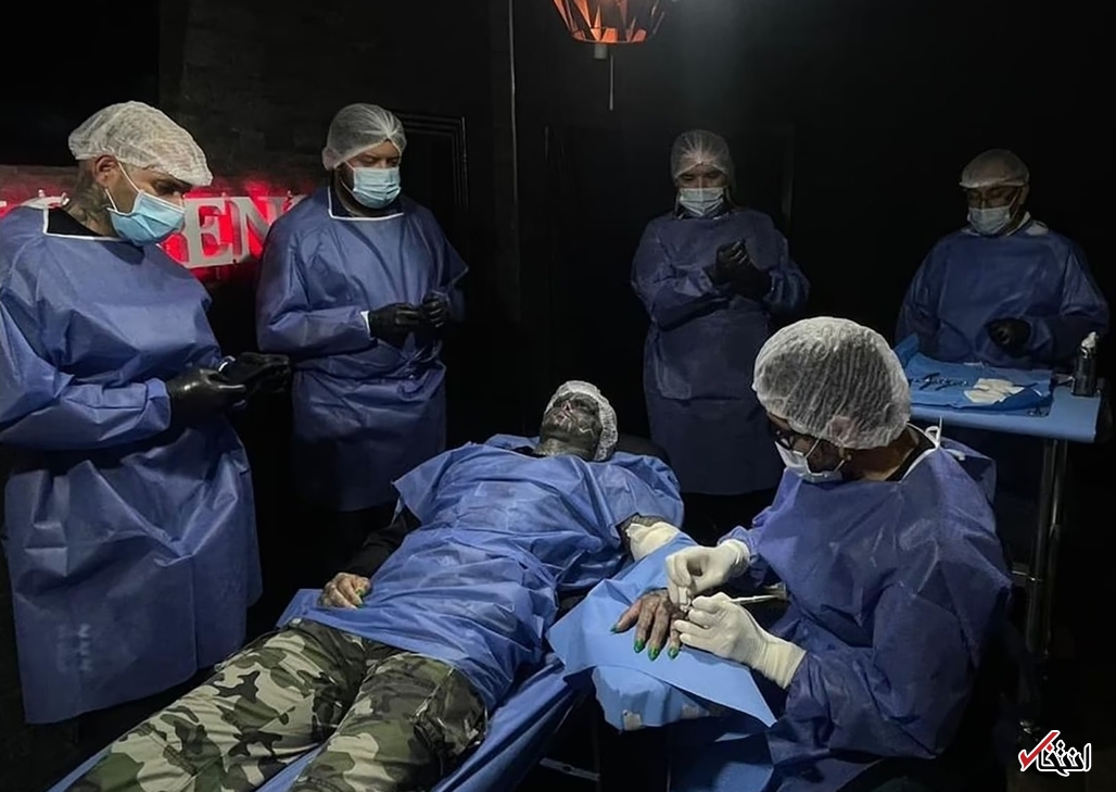 عجیب‌ترین جراحی زیبایی جهان/قطع انگشتان دست برای ایجاد پنجه! +تصاویر