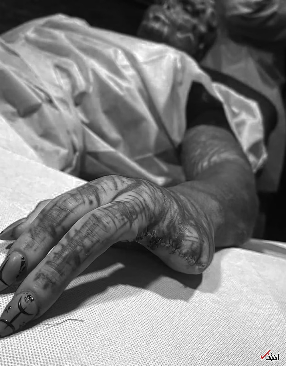 عجیب‌ترین جراحی زیبایی جهان/قطع انگشتان دست برای ایجاد پنجه! +تصاویر