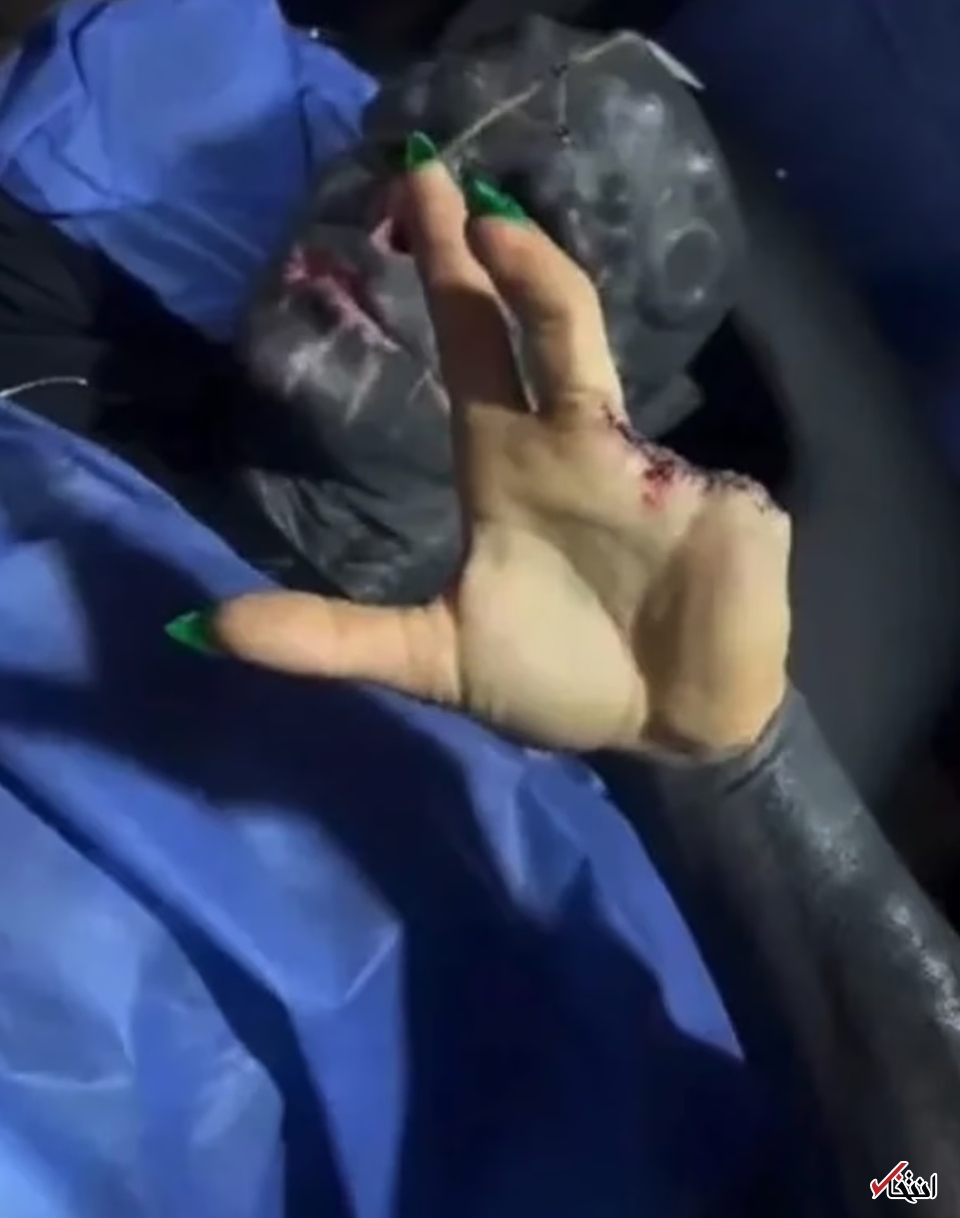 عجیب‌ترین جراحی زیبایی جهان/قطع انگشتان دست برای ایجاد پنجه! +تصاویر