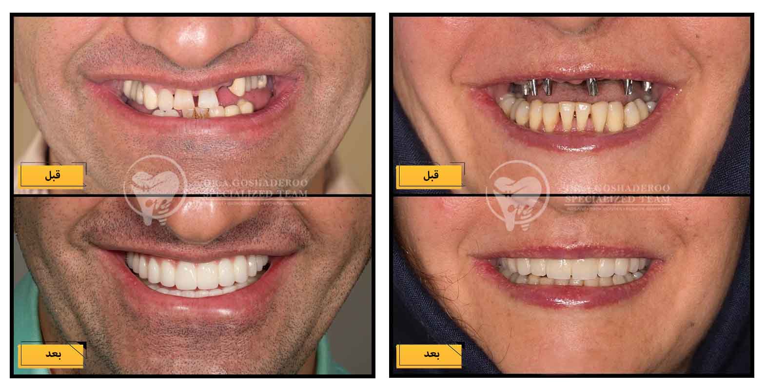 کاشت ایمپلنت دندان برای چه کسانی توصیه میشود؟