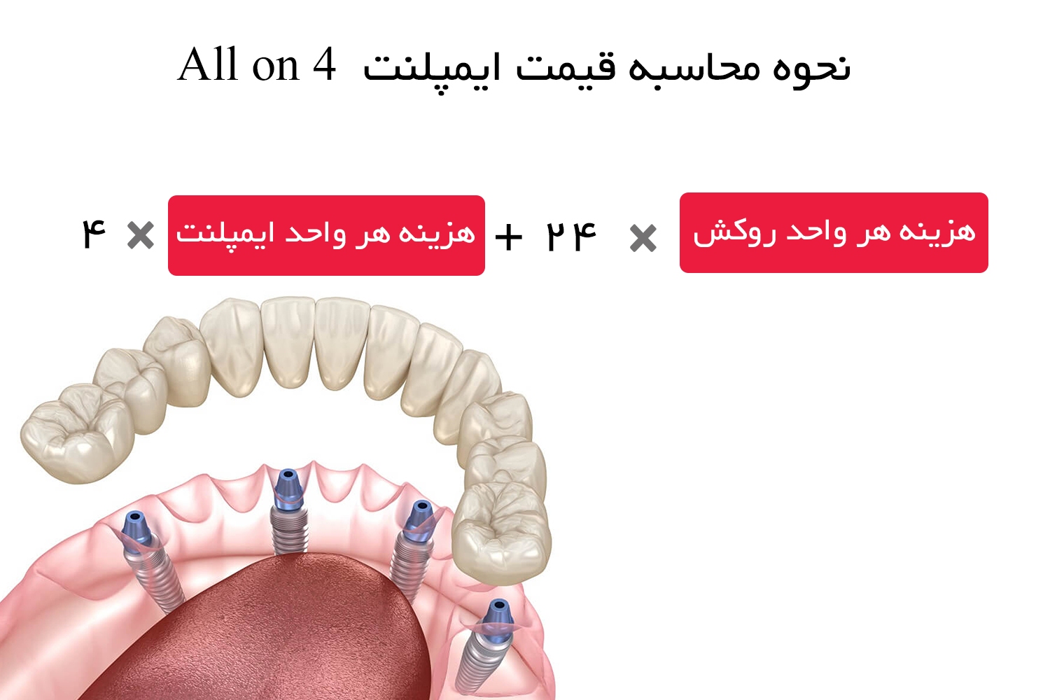 هزینه ایمپلنت دندان به روش All On 4