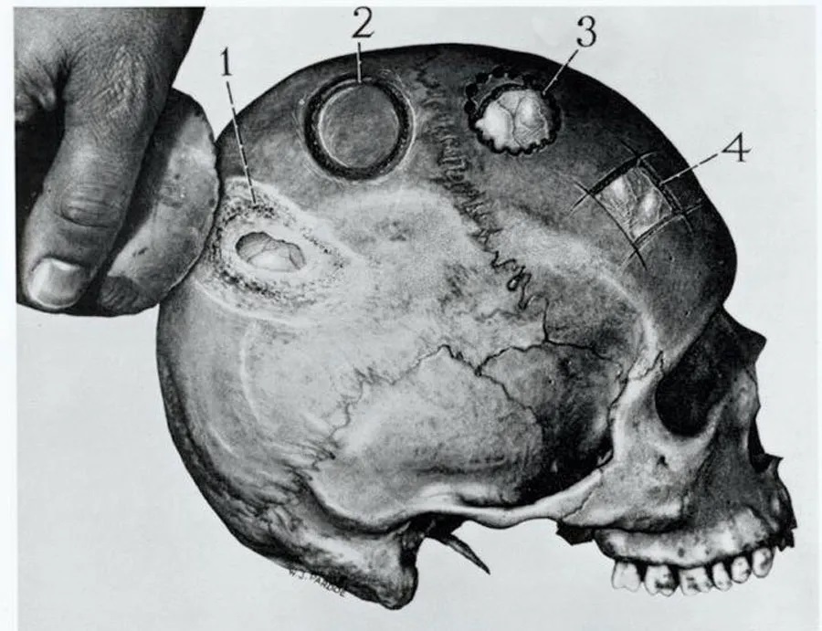 باستان‌شناسان از جزئیات هولناک جراحی مغز ۳۵۰۰ ساله پرده برداشتند