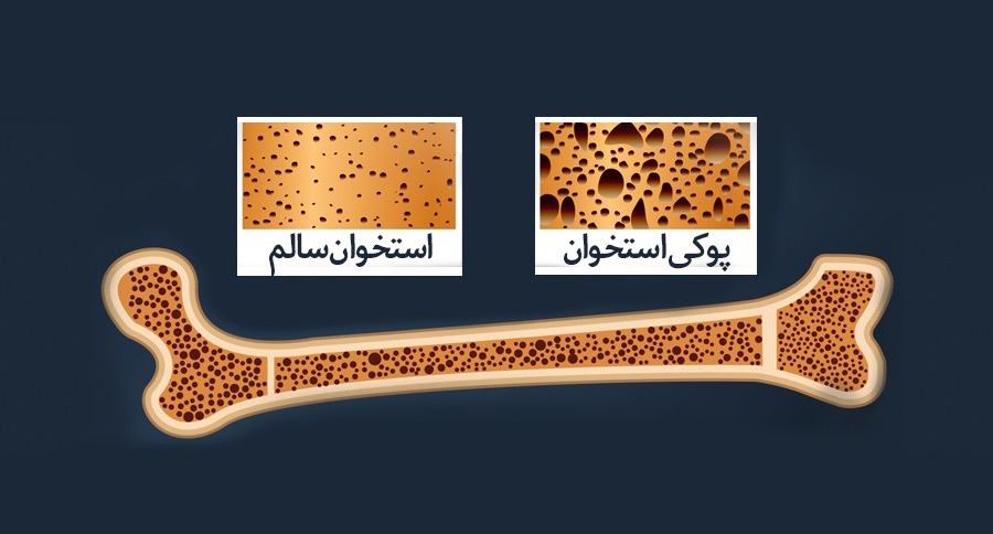 چرا جهان بر علیه پوکی استخوان هم داستان شده است؟ چرا جهان بر علیه پوکی استخوان هم داستان شده است؟