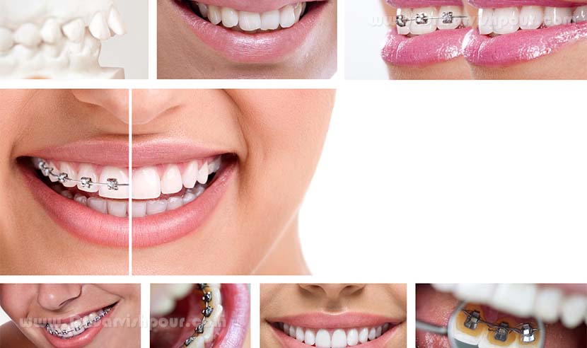 با ارتودنسی دندان و هزینه آن آشنا شوید با ارتودنسی دندان و هزینه آن آشنا شوید