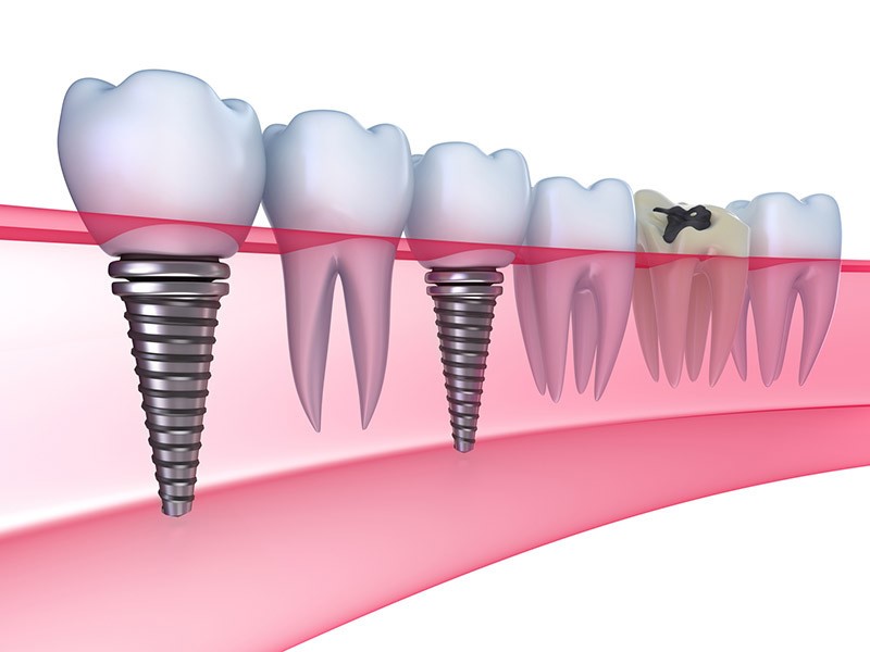 آیا ارتودنسی دندان های ایمپلنت شده امکان پذیر است؟