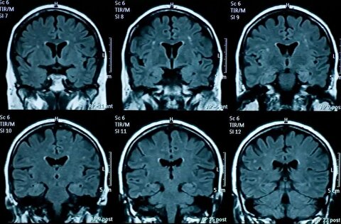 پژوهشی جدید: مغز نوجوانانی که در دوران قرنطینه کرونا زندگی کرده‌اند، سریع‌تر پیر می‌شود