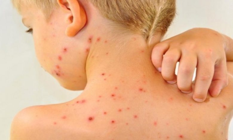 امکان ورود دوباره سرخک به کشور / شناسایی ۲۴۰ مورد مبتلا در سال گذشته امکان ورود دوباره سرخک به کشور / شناسایی ۲۴۰ مورد مبتلا در سال گذشته