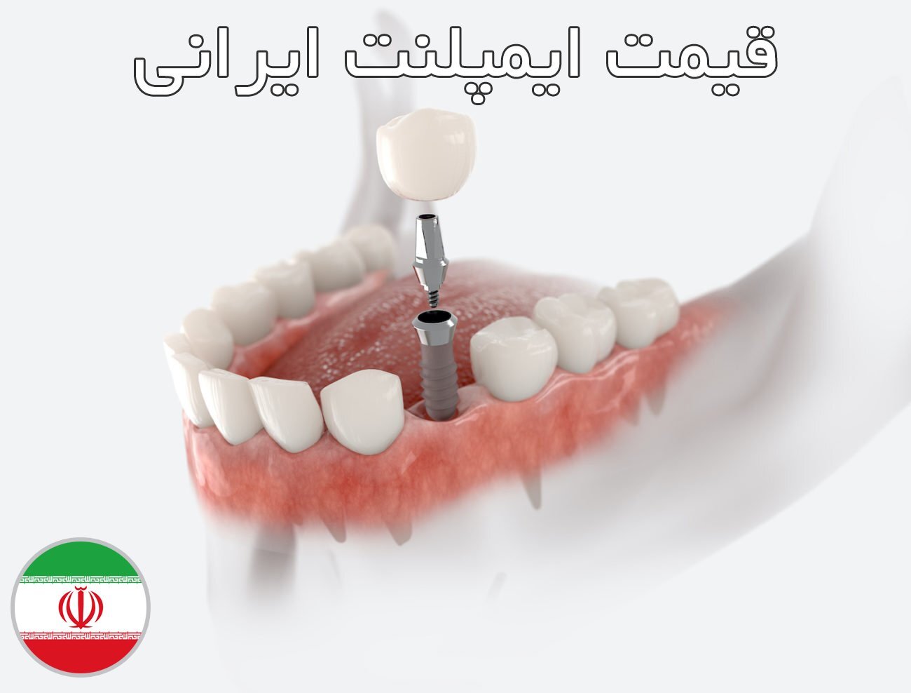 قیمت ایمپلنت ایرانی قیمت ایمپلنت ایرانی