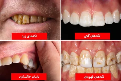 رنگ دندان از دیدگاه علم چه چیزهایی درباره سلامت شما می‌گوید؟