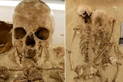 این اسکلت ۱۲ هزار ساله یک بیماری ژنتیکی نادر دارد!