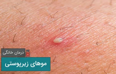 چند راهکار خانگی برای برطرف کردن موهای زیر پوستی