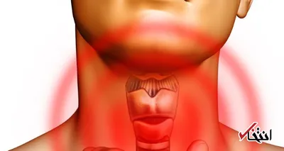 اگر تیروئید کم کار دارید به این نکات توجه کنید