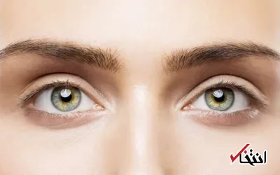 علل پف چشم ها پس از بیدار شدن از خواب چیست؟