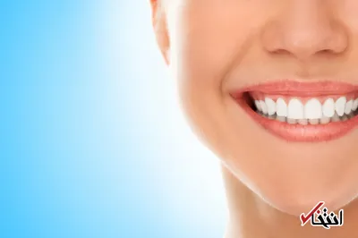 لمینت و کامپوزیت دندان چه تفاوتی دارد؟