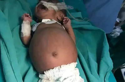 اتفاقی نادر در هند؛ تولد نوزادی که در شکمش جنین دوقلوی خود را داشت